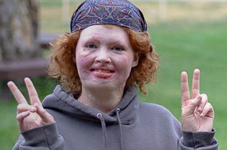 Picture for category Burn Patient and Family Recovery